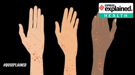 monkeypox featured img