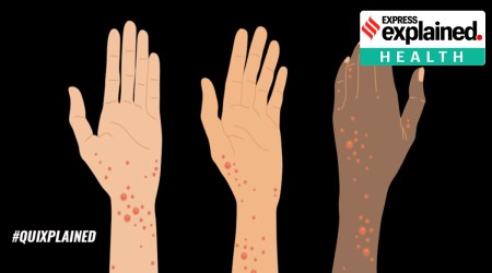 monkeypox featured img