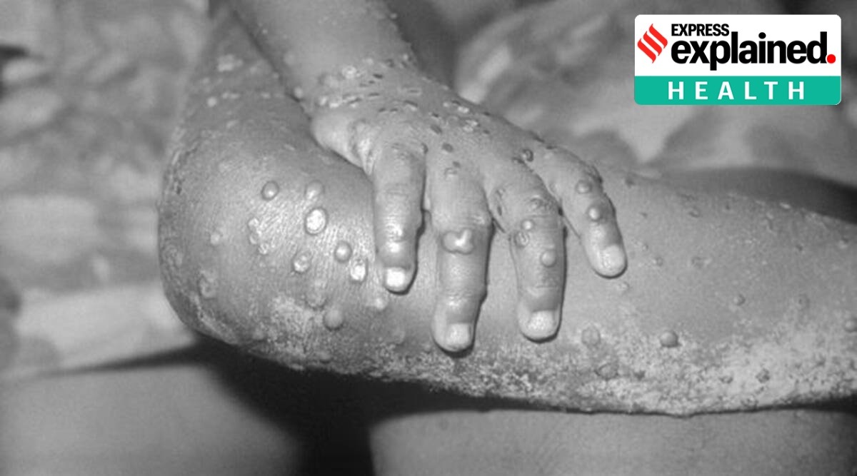 New symptoms of monkeypox in UK patients