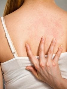 How to deal with back acne?