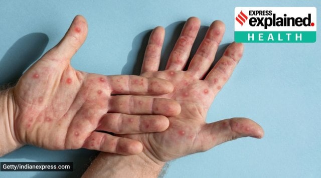 Hand-Foot-Mouth Disease | HFMD