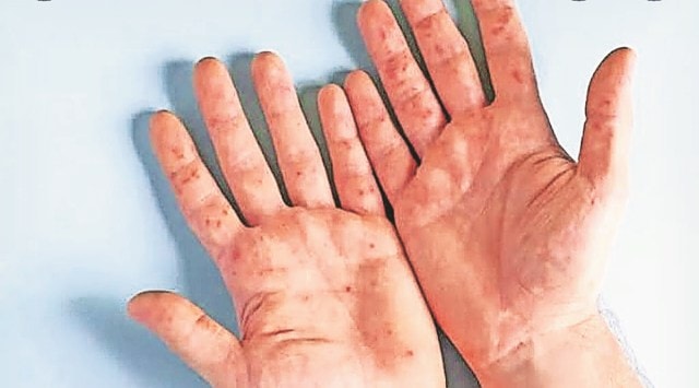 Pain, fever, bad appetite, small blisters and ulcers on hands, feet, mouth and other parts are the main symptoms. (Express Photo)