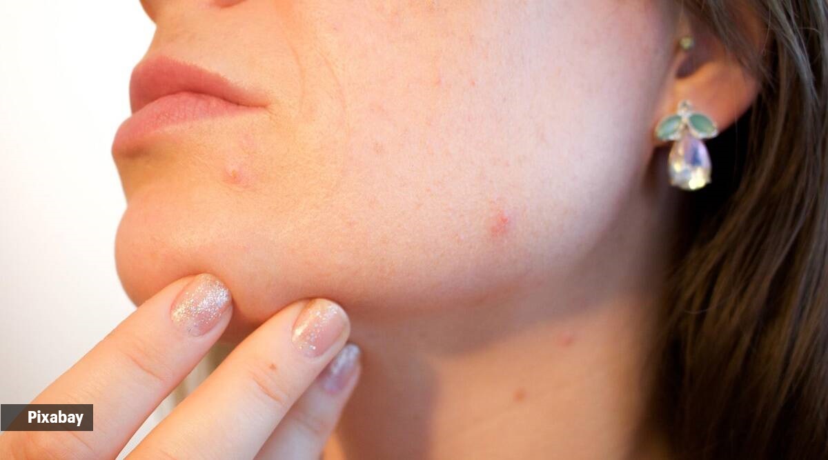 Will popping acne settle it faster? Find out here | Lifestyle News,The  Indian Express