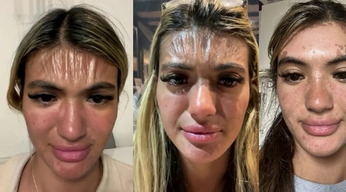 plastic forehead, sun damage