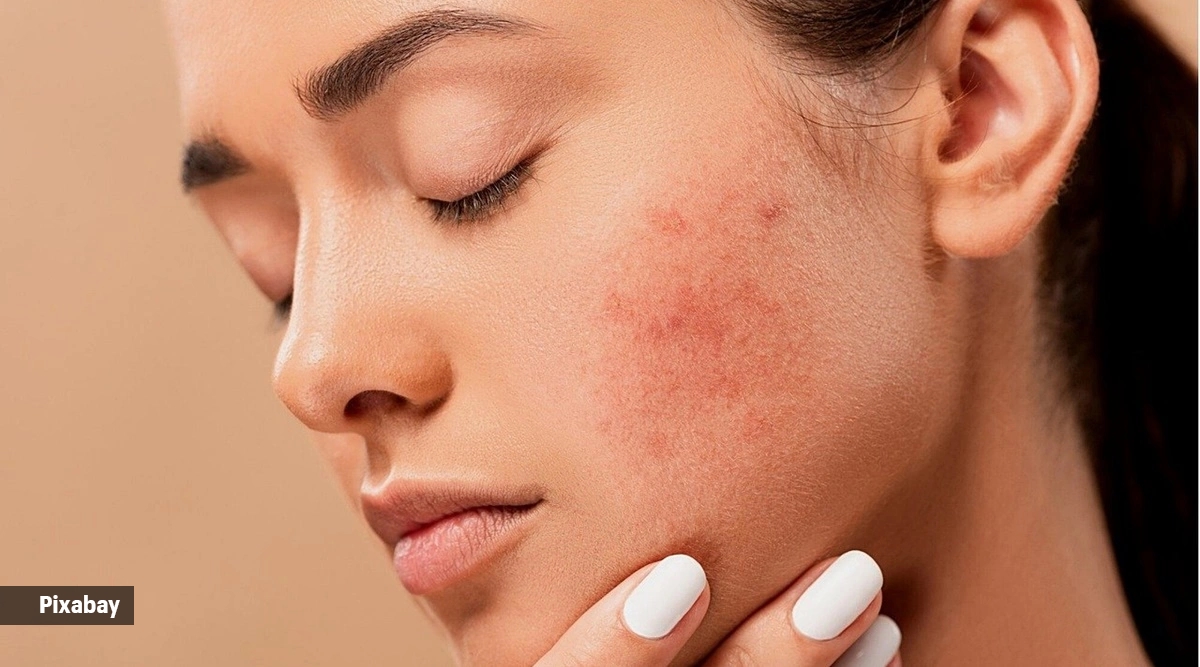 Skincare alert: Dietary dos and don’ts to control rosacea naturally