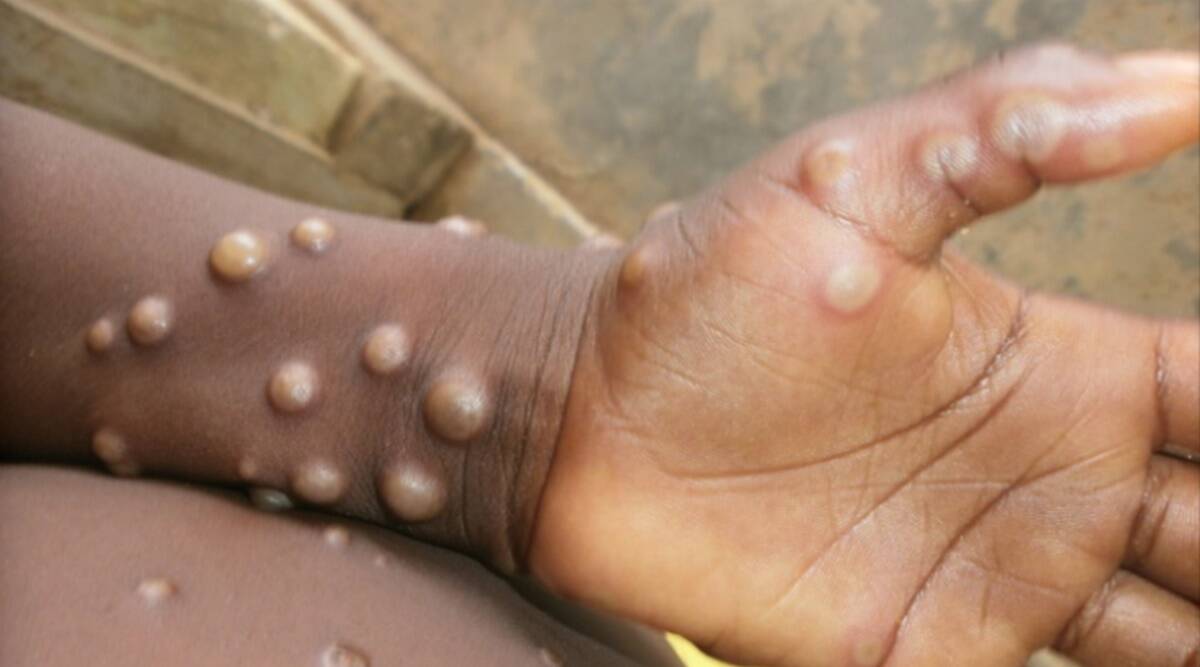 monkey pox