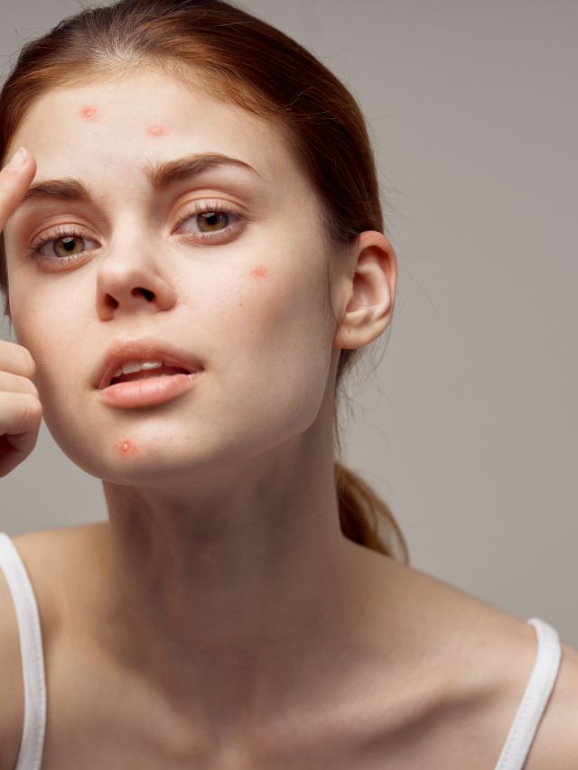 How to deal with forehead acne The Indian Express