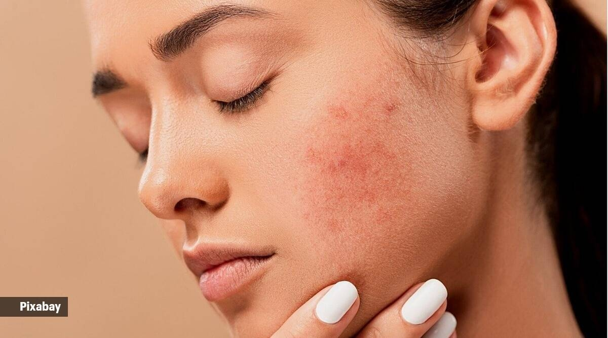From coconut oil to aloe vera, Ayurveda expert suggests home remedies to heal facial redness Life-style News photo