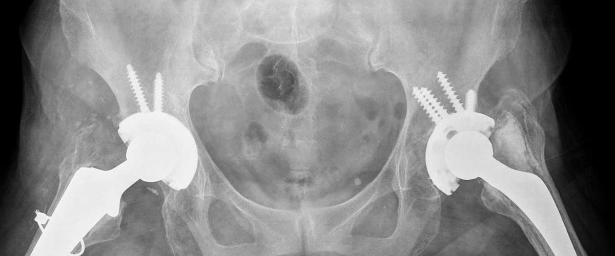 Hip replacement surgery X-Ray (Image source-John Hopkins University)