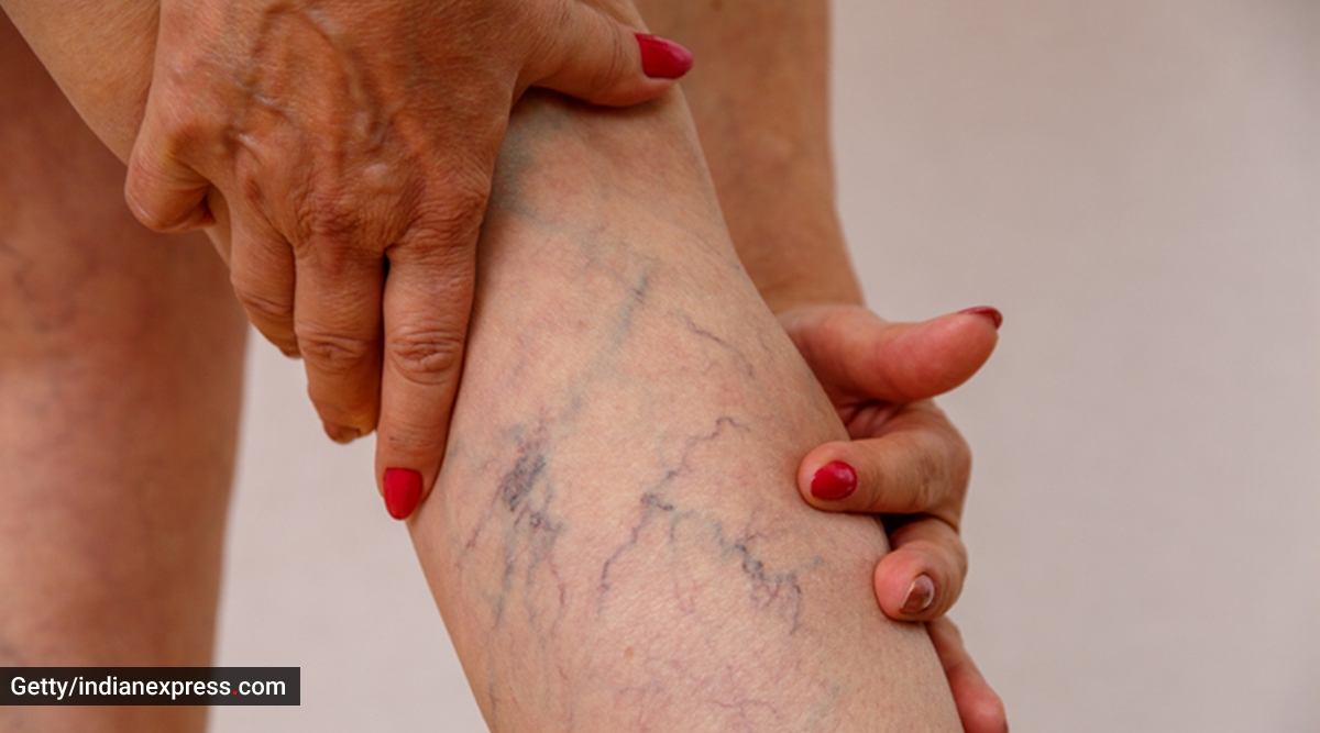 effective-tips-to-manage-varicose-veins-naturally