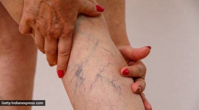 Varicose veins which are twisted enlarged veins that mostly appear in the legs and feet. (Photo: Getty images)