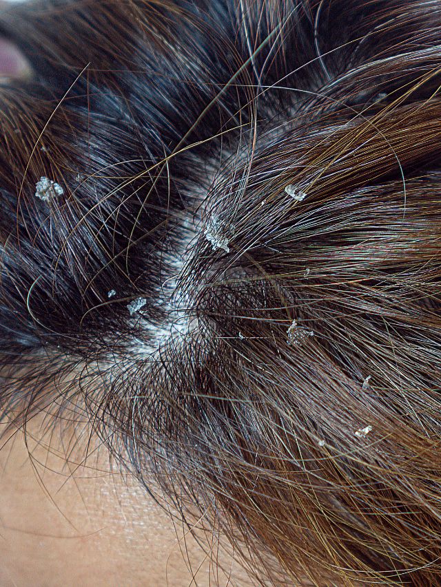 Ayurveda helps combat dandruff issues The Indian Express