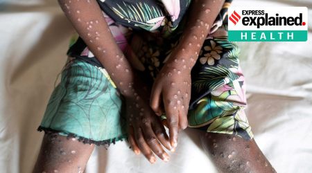 A 6-year-old who is suffering from suspected monkeypox, sits on a bed at the Yalolia health centre, Tshopo, Democratic Republic of Congo, October 3, 2022. (Reuters Photo: Arlette Bashizi)