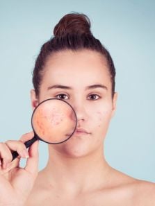 Mental impact of female adult acne
