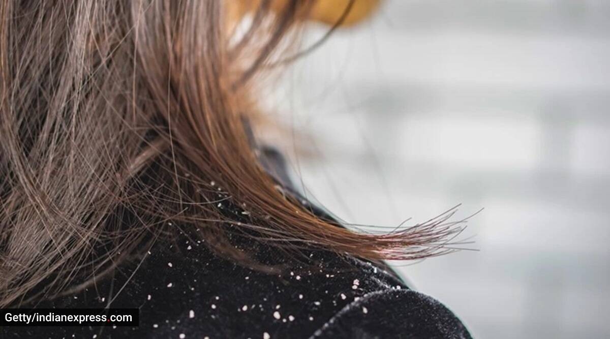 Say goodbye to dandruff and itchy scalp with this three-ingredient  Ayurvedic hair mask | Lifestyle News,The Indian Express