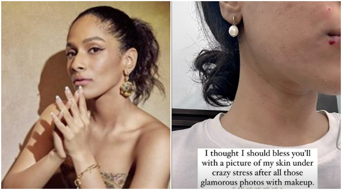 Masaba Gupta shares picture of her skin ‘under crazy stress’; know what can help