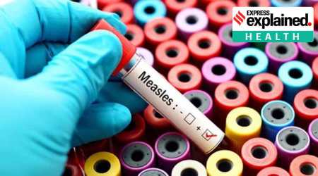 Measles or as it is called ‘khasra’, is a highly contagious viral disease which affects mostly children.