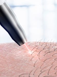 Why it is important to shave before laser hair removal