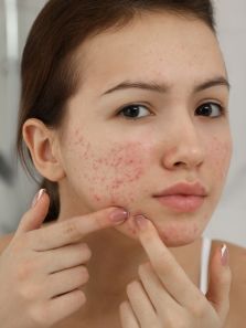 Why you should avoid dairy, high glycemic index food if you have acne