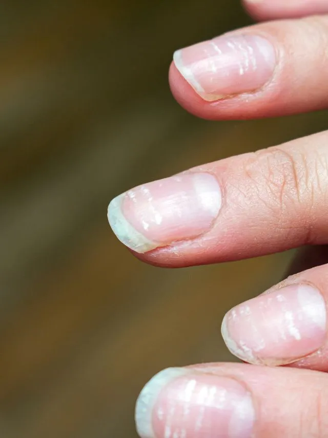 The Appearance of Your Nails Tells a Lot About Your Health - News18