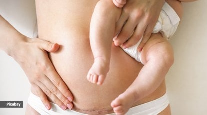 Post-pregnancy care: Effective tips for a faster C-section