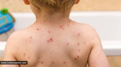 Chickenpox, Chickenpox cases, Bengal Chickenpox cases, kolkata Chickenpox cases, West Bengal, Kolkata, Indian Express, current affairs