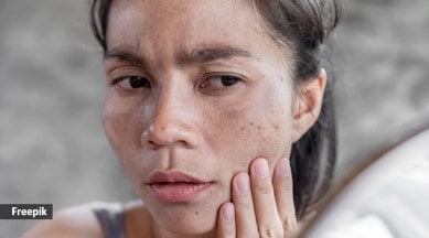 Hyperpigmentation