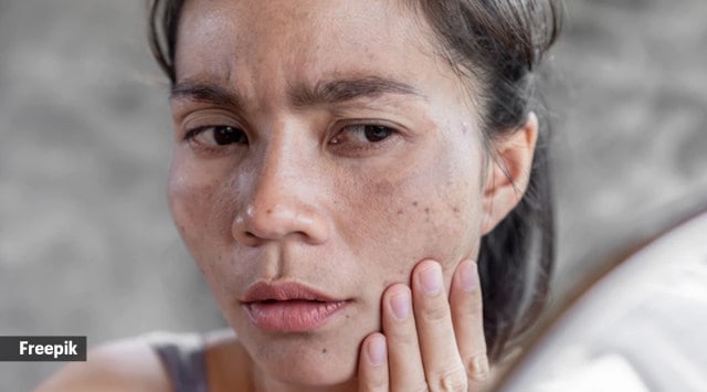 Things you must (and not) do to manage hyperpigmentation | Life-style ...