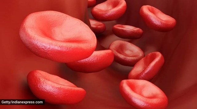 sickle cell anaemia