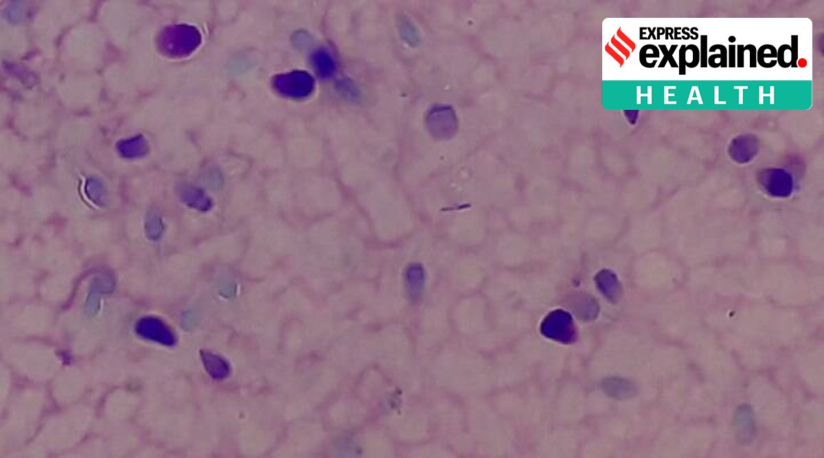 Sperm under the microscope using the Leishman staining technique.