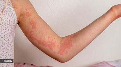 26 Pictures Of Skin Rashes—What Common Skin Rashes Look Like