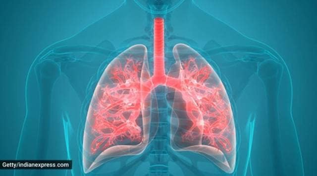 bird breeder lung disease