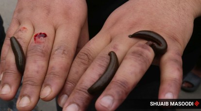 As many ailing people get leech therapy done in Kashmir on Navroz,  understanding what the procedure entails