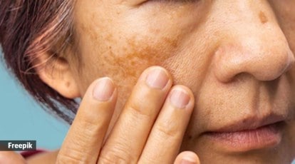 Post-Inflammatory Hyperpigmentation (PIH) on the Skin