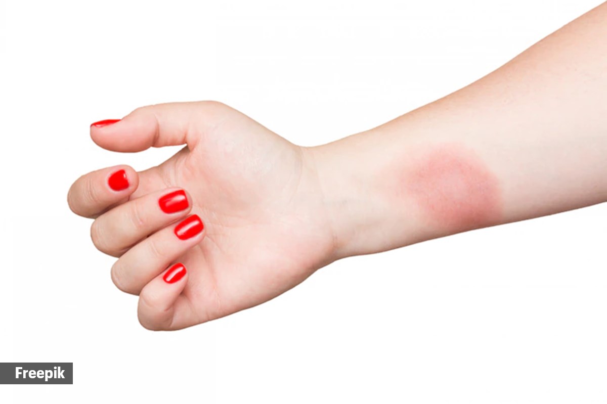 In case of wax burns, this is when you should consult a dermatologist