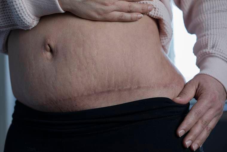 Gina D'Addario of Syracuse, N.Y., shows scars from surgeries she required after experiencing unwanted side effects from a CoolSculpting procedure, on March 19, 2023. (Amrita Stuetzle/The New York Times)