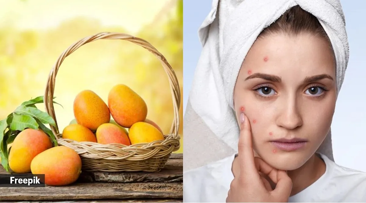 Myth or fact: Mangoes cause zits and pimples | Health News - The Indian ...