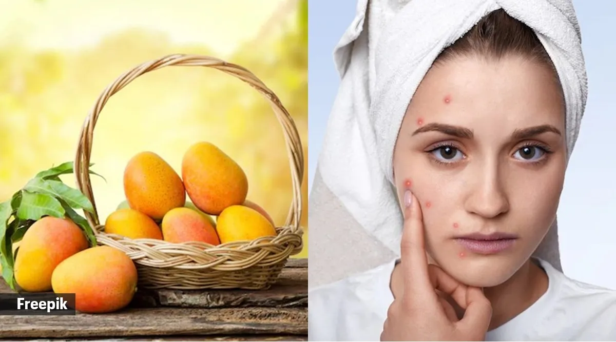 Myth or fact Mangoes cause zits and pimples Health News The Indian