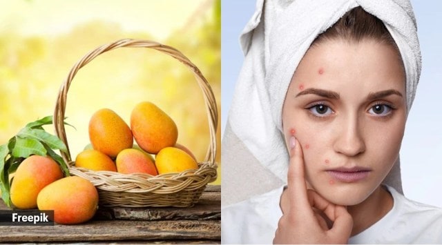 Assisting in preventing acne diet right fruits