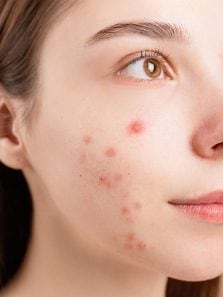 Remedies to combat acne, pimples, and breakouts