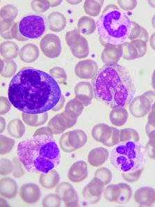 Manipulated macrophages show promise in the treatment of solid tumours