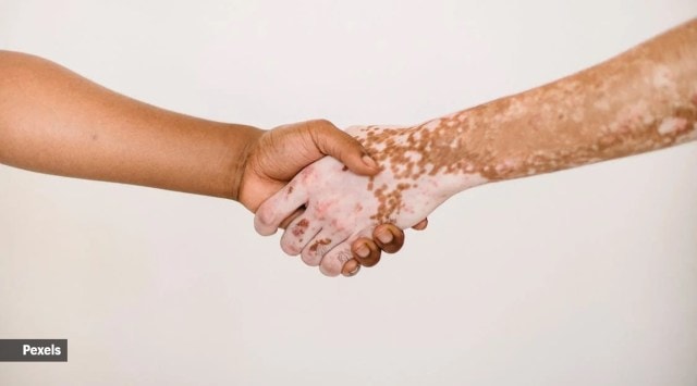 vitiligo_200_pexels.jpg?w=640