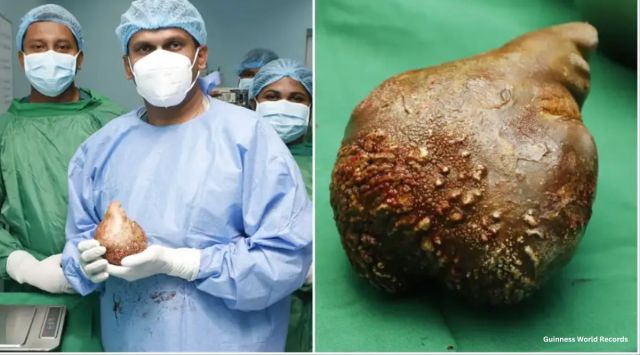 world's largest kidney stone
