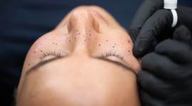 A woman during her freckles tattoo application, where the dots are first drawn on with a waterproof marker as a test placement before the real ones are later added with semipermanent liquid pigment, in New York, June 14, 2023. (Earl Wilson/The New York Times)