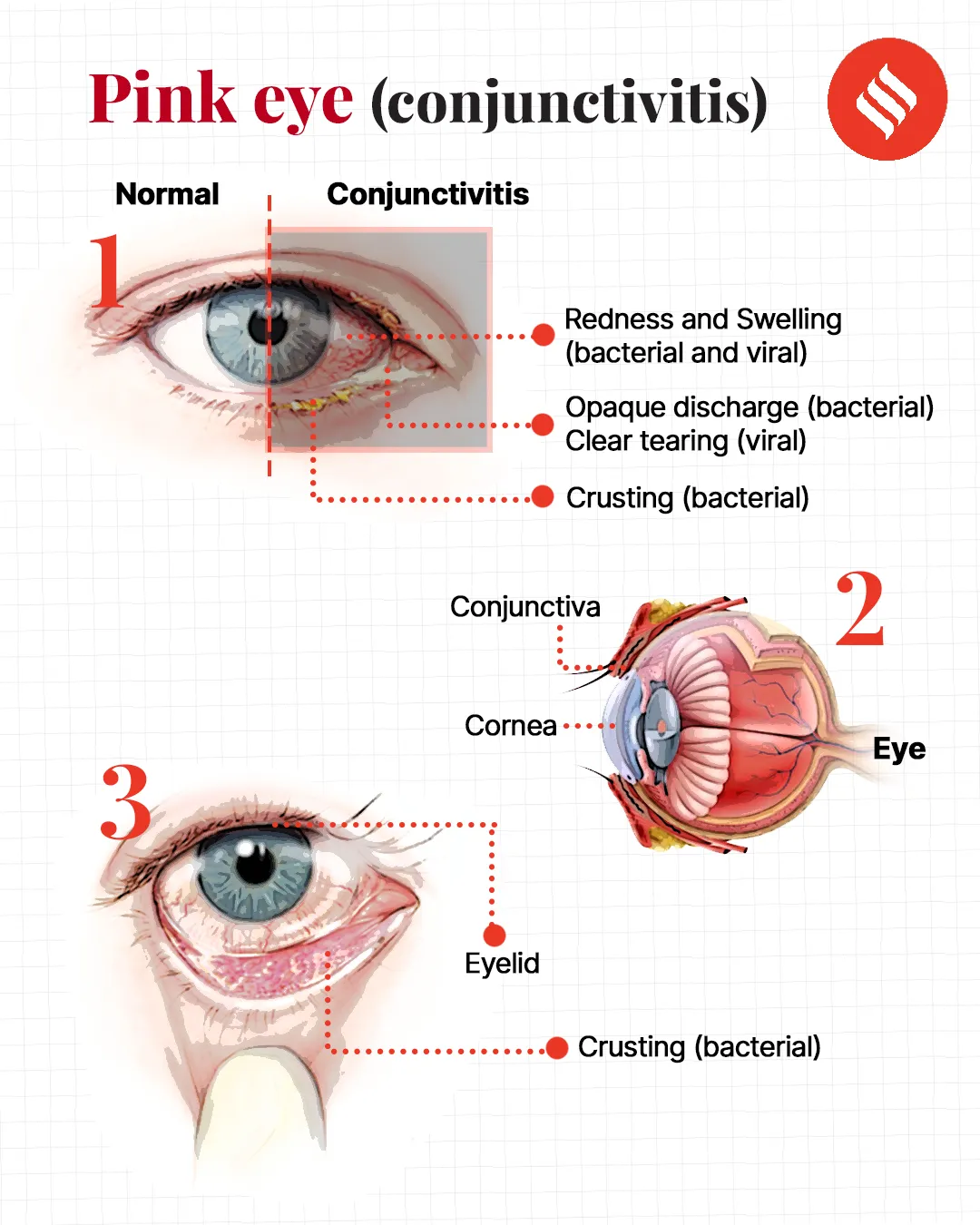 5 Causes Why sudden spike in Conjunctivitis? - Asiana Times