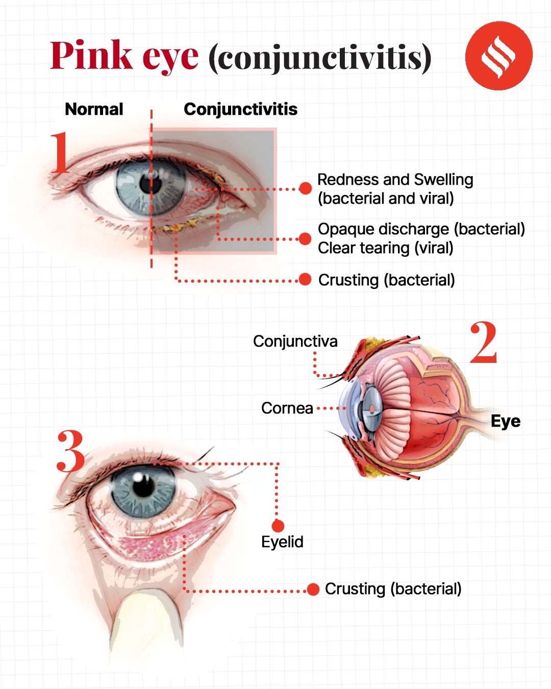 difference between viral and bacterial pink eye