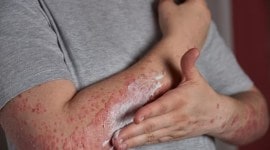 eczema