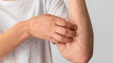 fungal infections