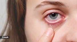 conjunctivitis