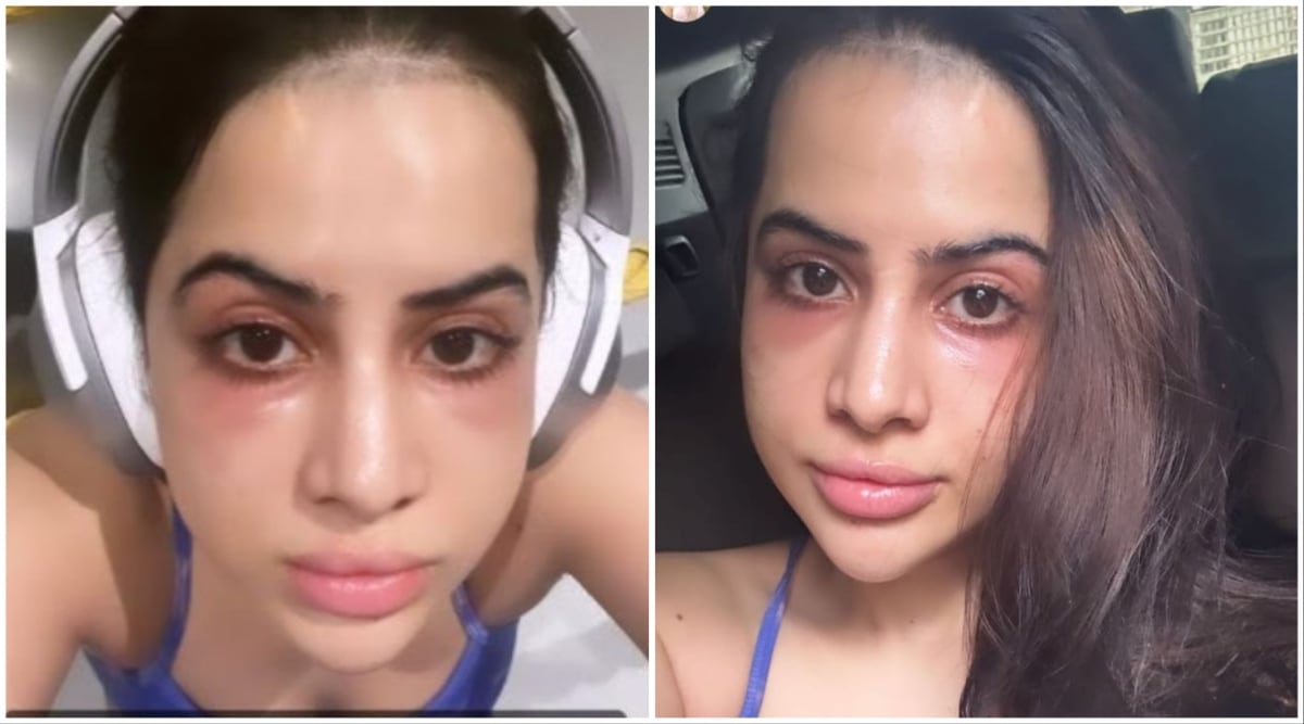 Uorfi Javed gets undereye fillers after being trolled, laments over